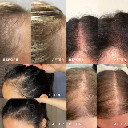 Microneedle Infusion System for Hair Growth