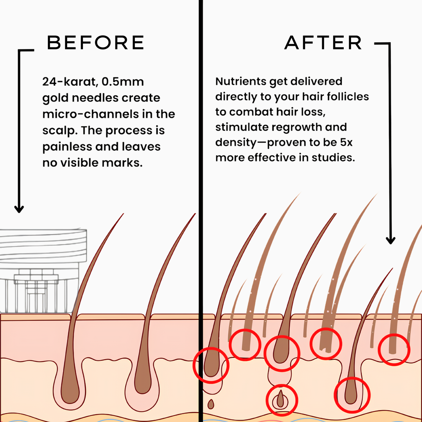 Microneedle Infusion System for Hair Growth