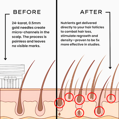 Microneedle Infusion System for Hair Growth
