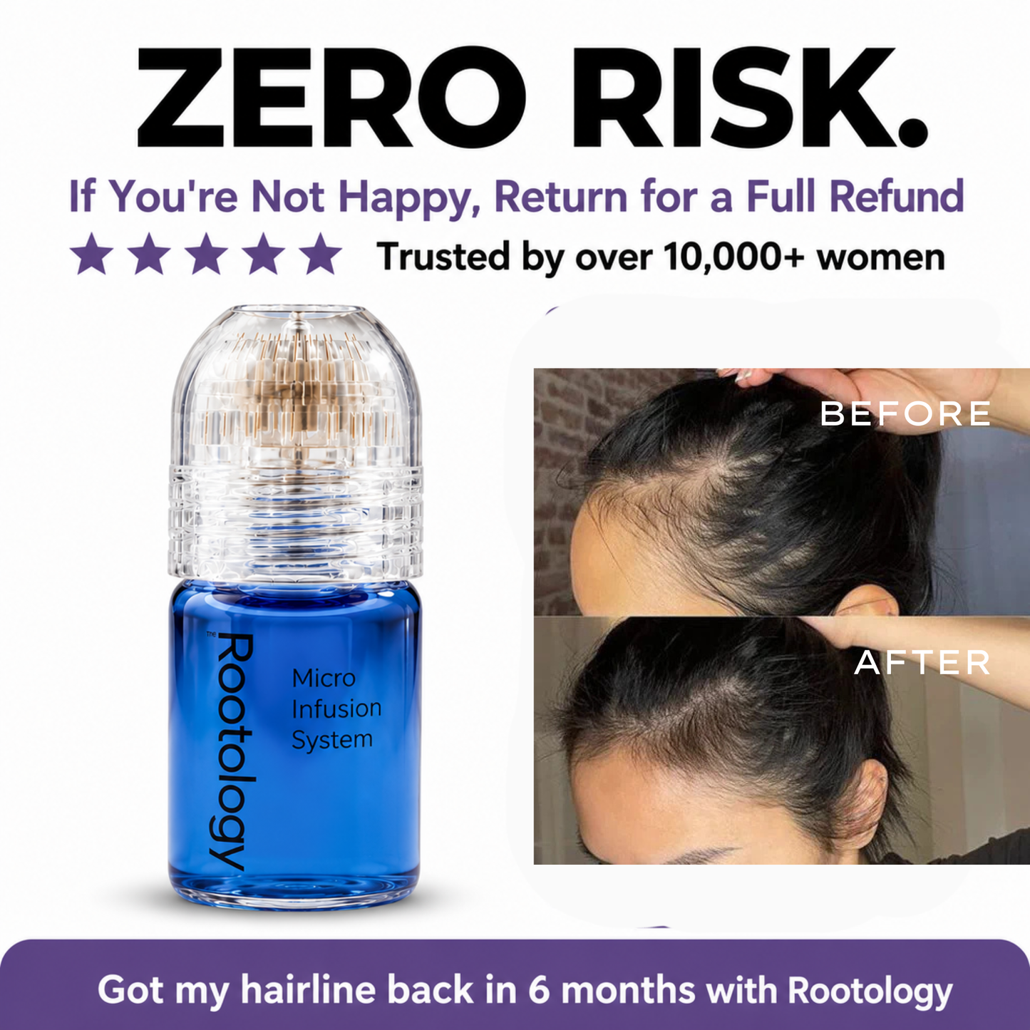 Peptide Microneedle Infusion System for Hair Growth