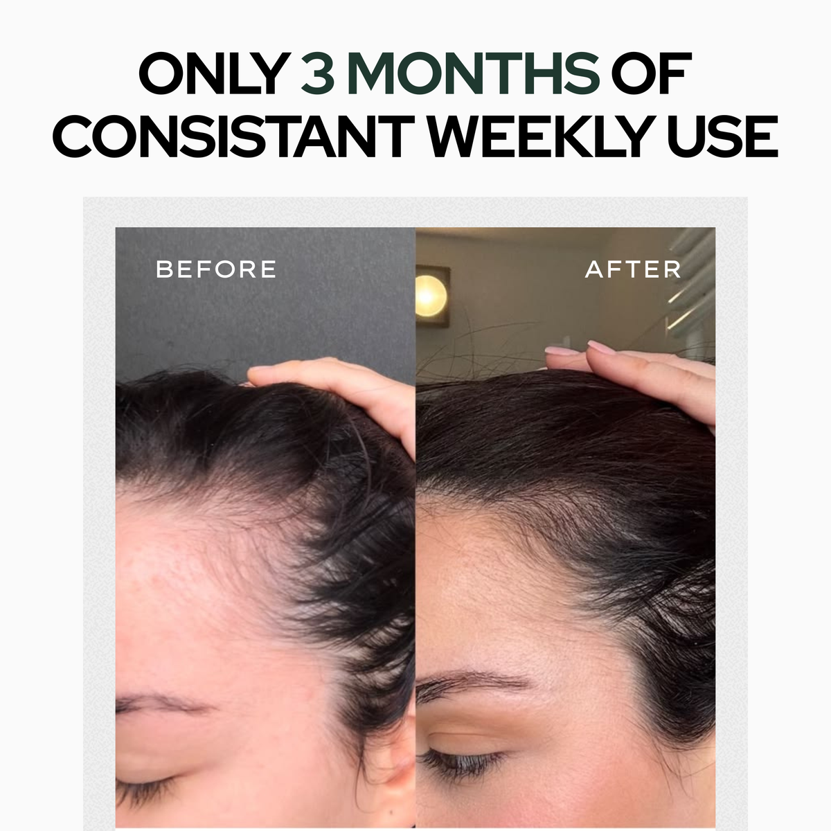 Peptide Microneedle Infusion System for Hair Growth