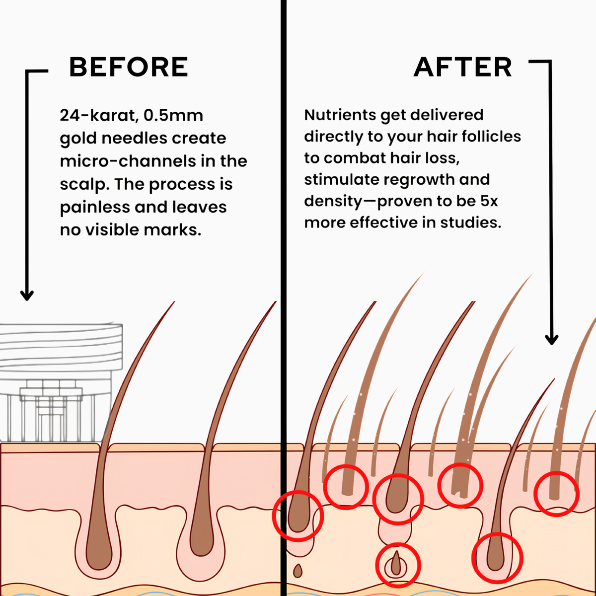 Peptide Microneedle Infusion System for Hair Growth