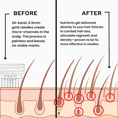 Peptide Microneedle Infusion System for Hair Growth