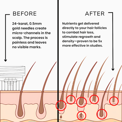 Reverse GLP-1 Hair Loss In 60 Days With Rootology™ Micro Infusion