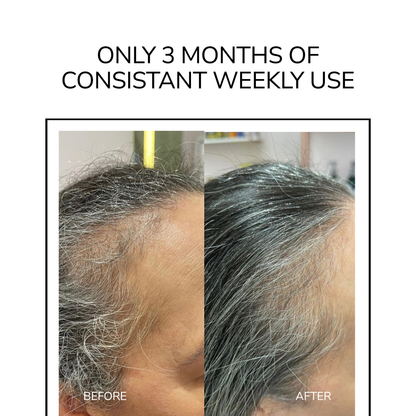 Reverse GLP-1 Hair Loss In 60 Days With Rootology™ Micro Infusion